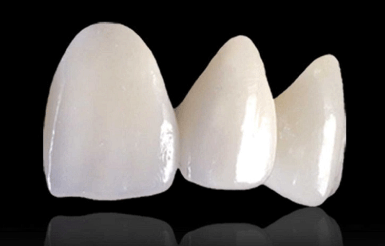 審美歯科の種類
